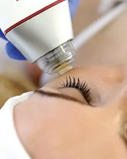 Gold Needle RF treatment at Dermalanya Oba Alanya