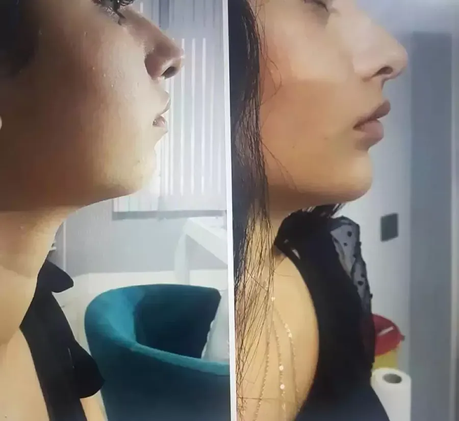 Chin Filler
