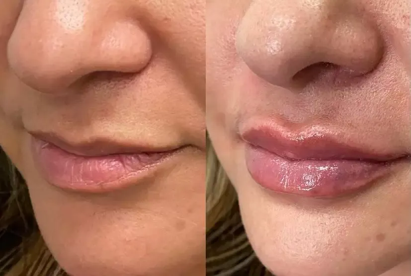 Lip Filler
