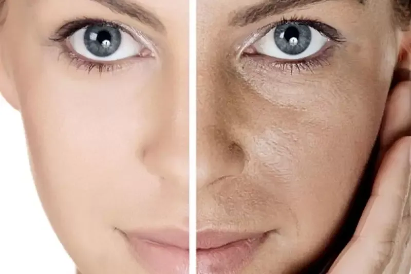Enlarged Pore Treatment