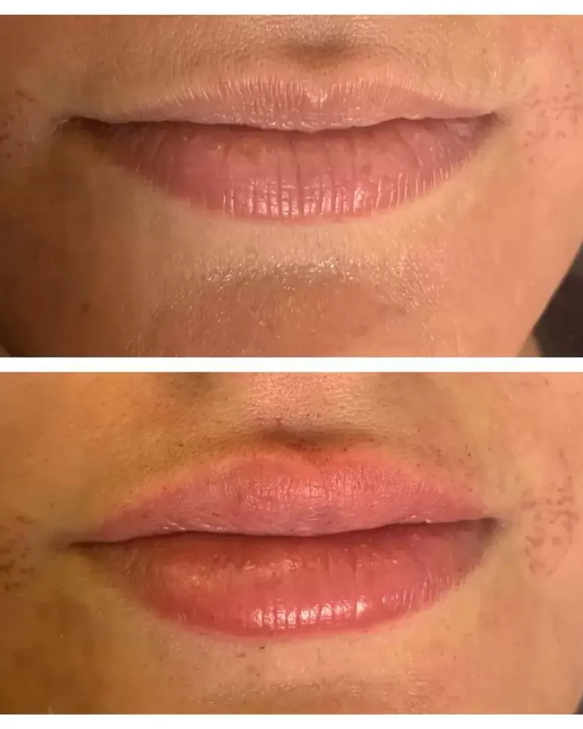 Needle-Free Lip Filler treatment at Dermalanya Oba Alanya