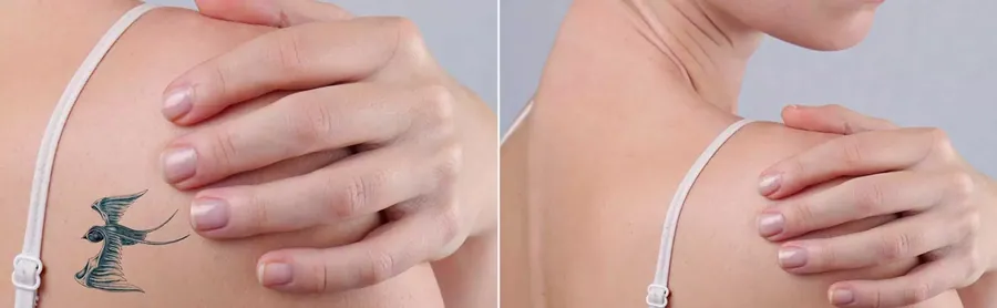 Laser Tattoo Removal