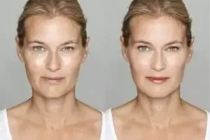 Fruit Acid Peel