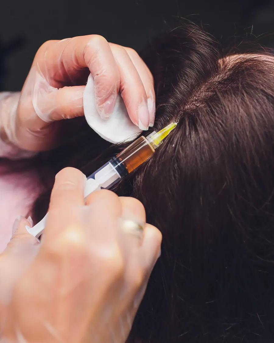 Hair Mesotherapy treatment at Dermalanya Oba Alanya