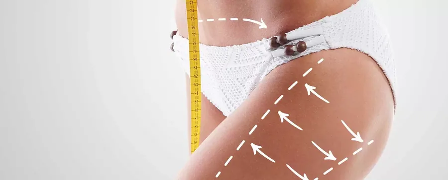 Cellulite Mesotherapy