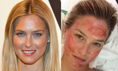 Vampire Facelift (Rejuvenation with Your Own Blood) — Dermalanya Alanya